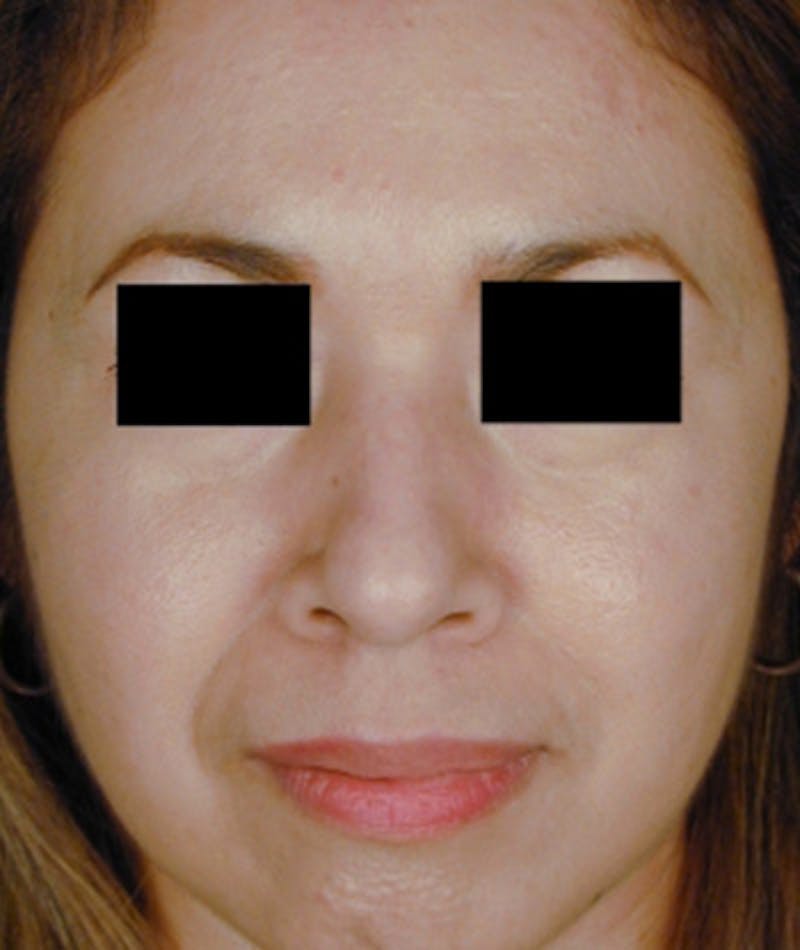 Ethnic Rhinoplasty Before & After Gallery - Patient 108189887 - Image 3