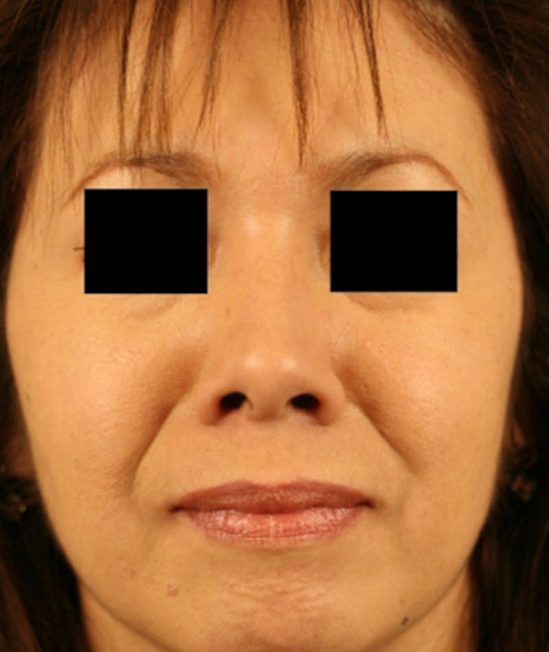 Ethnic Rhinoplasty Before & After Gallery - Patient 108189887 - Image 4