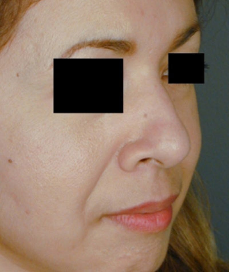 Ethnic Rhinoplasty Before & After Gallery - Patient 108189887 - Image 5