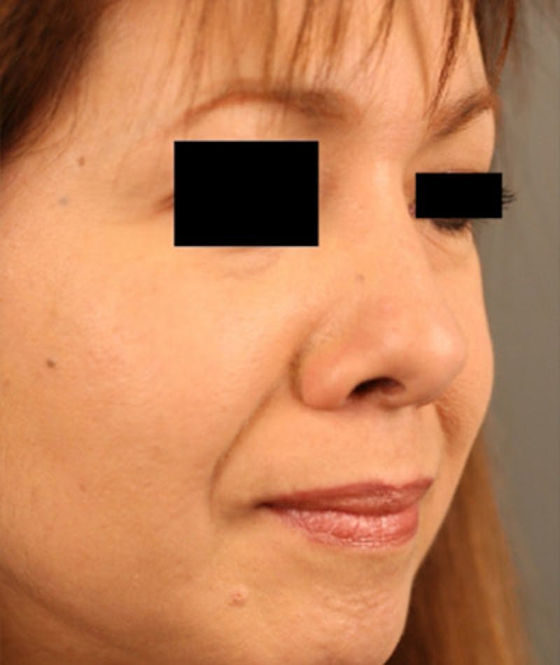 Ethnic Rhinoplasty Before & After Gallery - Patient 108189887 - Image 6