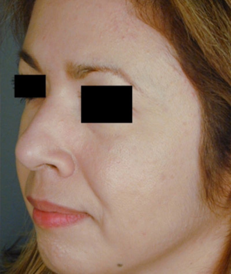 Ethnic Rhinoplasty Before & After Gallery - Patient 108189887 - Image 7