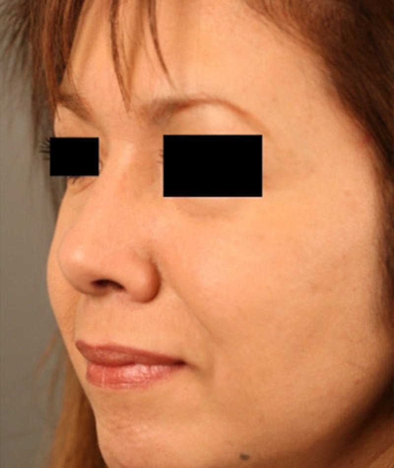 Ethnic Rhinoplasty Before & After Gallery - Patient 108189887 - Image 8