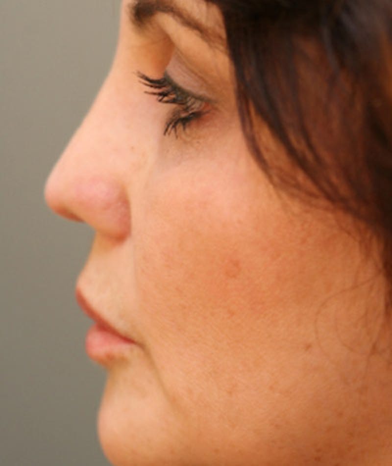 Ethnic Rhinoplasty Before & After Gallery - Patient 108189888 - Image 2