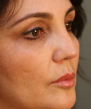 Ethnic Rhinoplasty Before & After Gallery - Patient 108189888 - Image 4