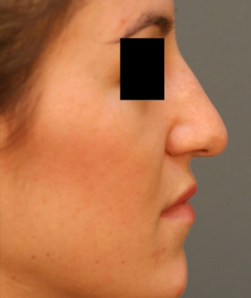 Ethnic Rhinoplasty Before & After Gallery - Patient 108189891 - Image 1