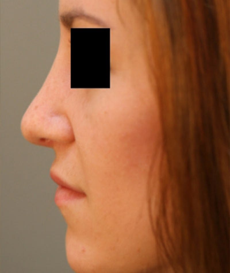 Ethnic Rhinoplasty Before & After Gallery - Patient 108189891 - Image 2