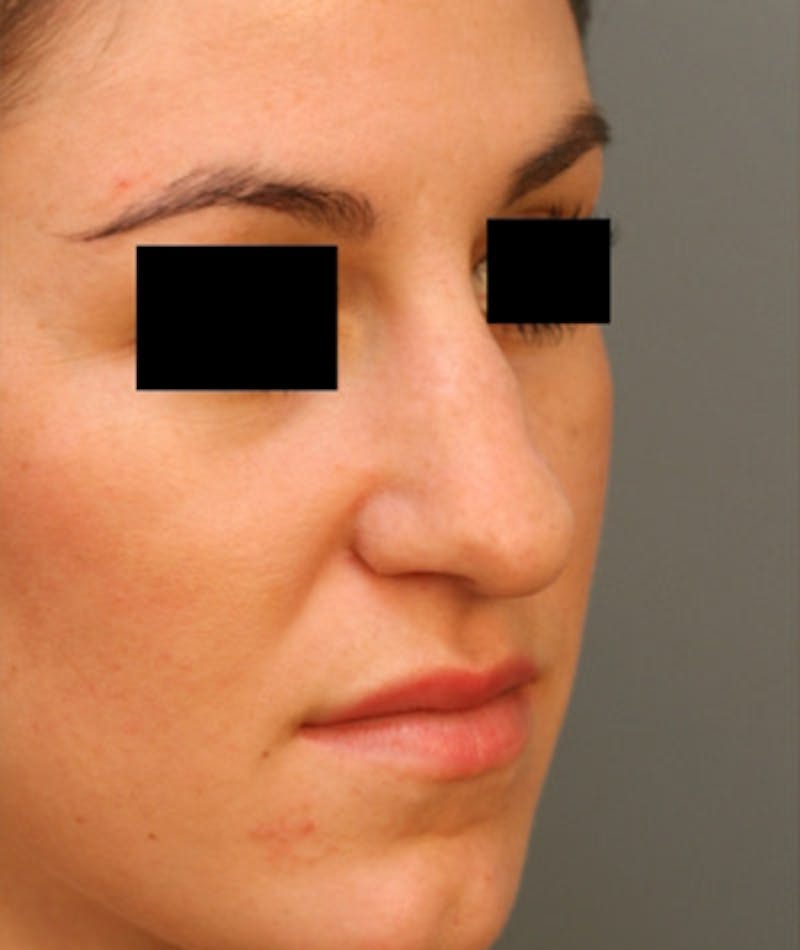 Ethnic Rhinoplasty Before & After Gallery - Patient 108189891 - Image 3