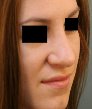 Ethnic Rhinoplasty Before & After Gallery - Patient 108189891 - Image 4