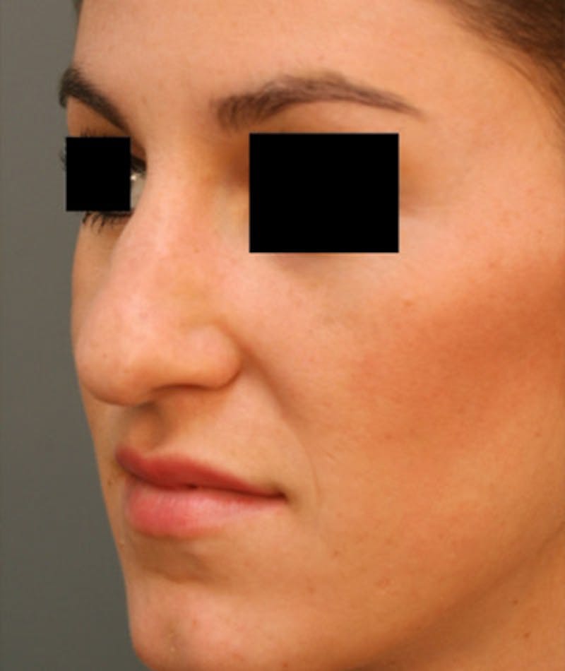 Ethnic Rhinoplasty Before & After Gallery - Patient 108189891 - Image 5