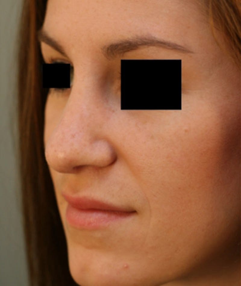 Ethnic Rhinoplasty Before & After Gallery - Patient 108189891 - Image 6