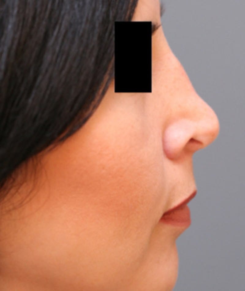 Ethnic Rhinoplasty Before & After Gallery - Patient 108189892 - Image 1