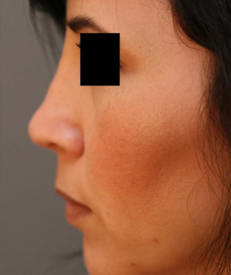 Ethnic Rhinoplasty Before & After Gallery - Patient 108189892 - Image 2