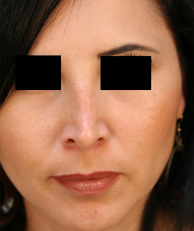 Ethnic Rhinoplasty Before & After Gallery - Patient 108189892 - Image 3