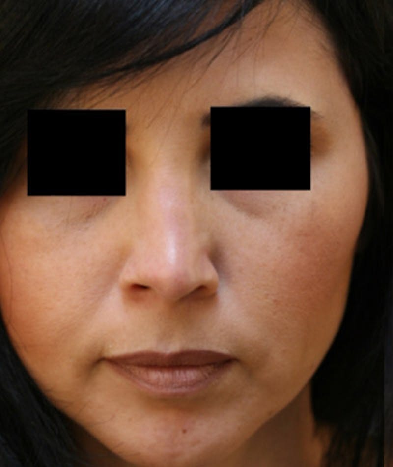 Ethnic Rhinoplasty Before & After Gallery - Patient 108189892 - Image 4