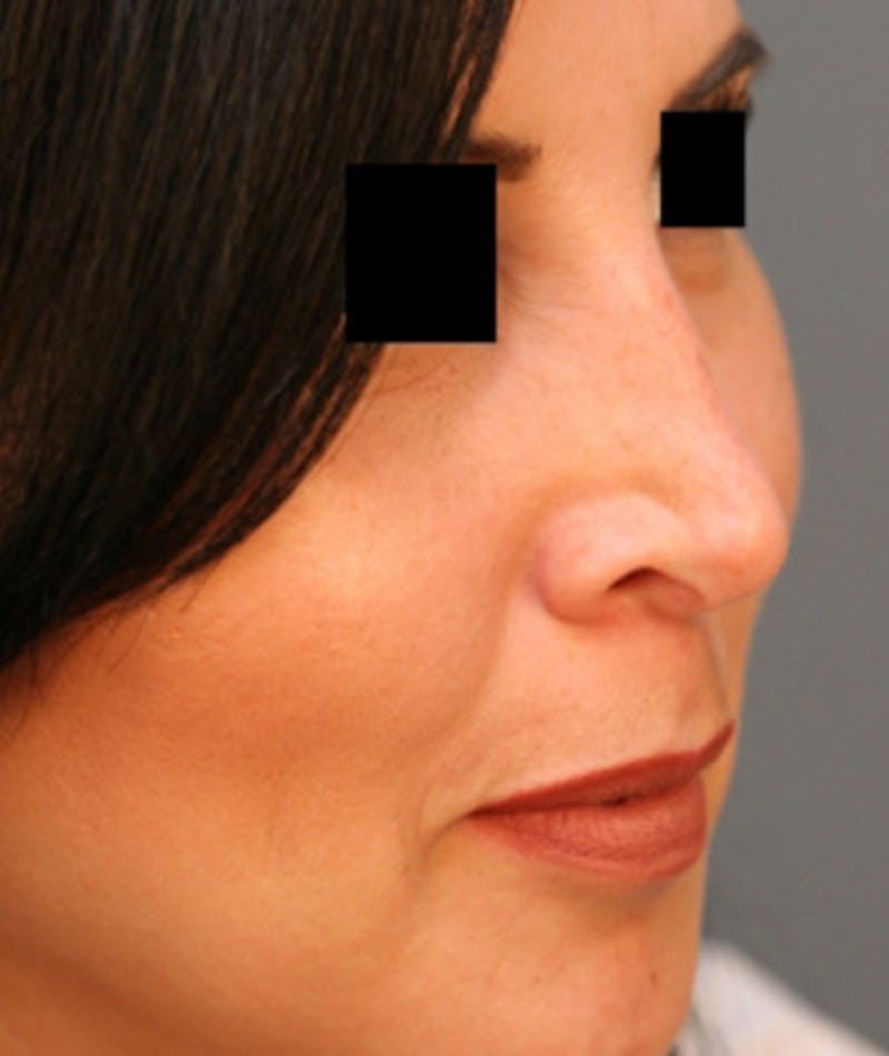 Ethnic Rhinoplasty Before & After Gallery - Patient 108189892 - Image 5