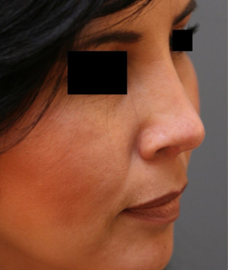 Ethnic Rhinoplasty Before & After Gallery - Patient 108189892 - Image 6
