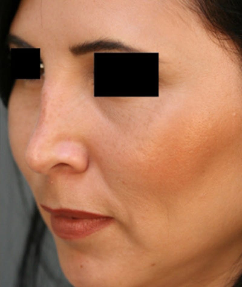 Ethnic Rhinoplasty Before & After Gallery - Patient 108189892 - Image 7