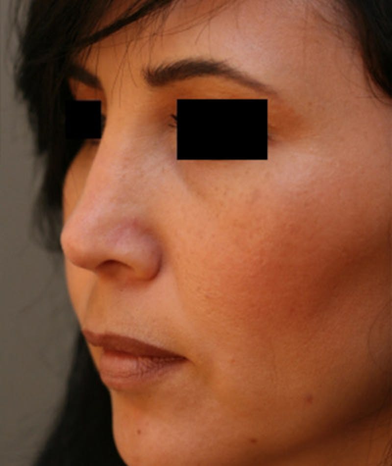 Ethnic Rhinoplasty Before & After Gallery - Patient 108189892 - Image 8