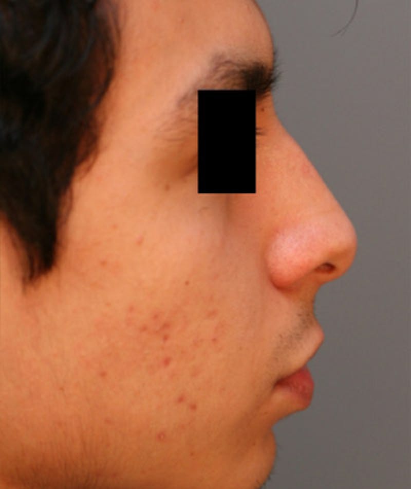 Ethnic Rhinoplasty Before & After Gallery - Patient 108189895 - Image 1