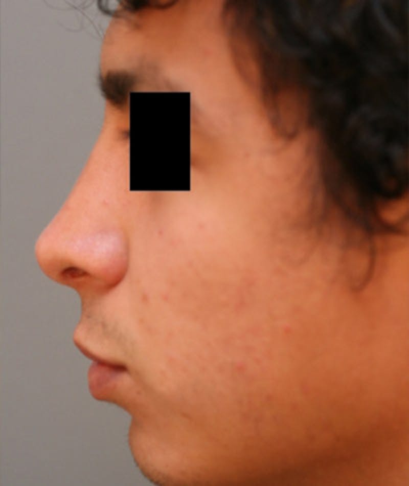 Ethnic Rhinoplasty Before & After Gallery - Patient 108189895 - Image 2