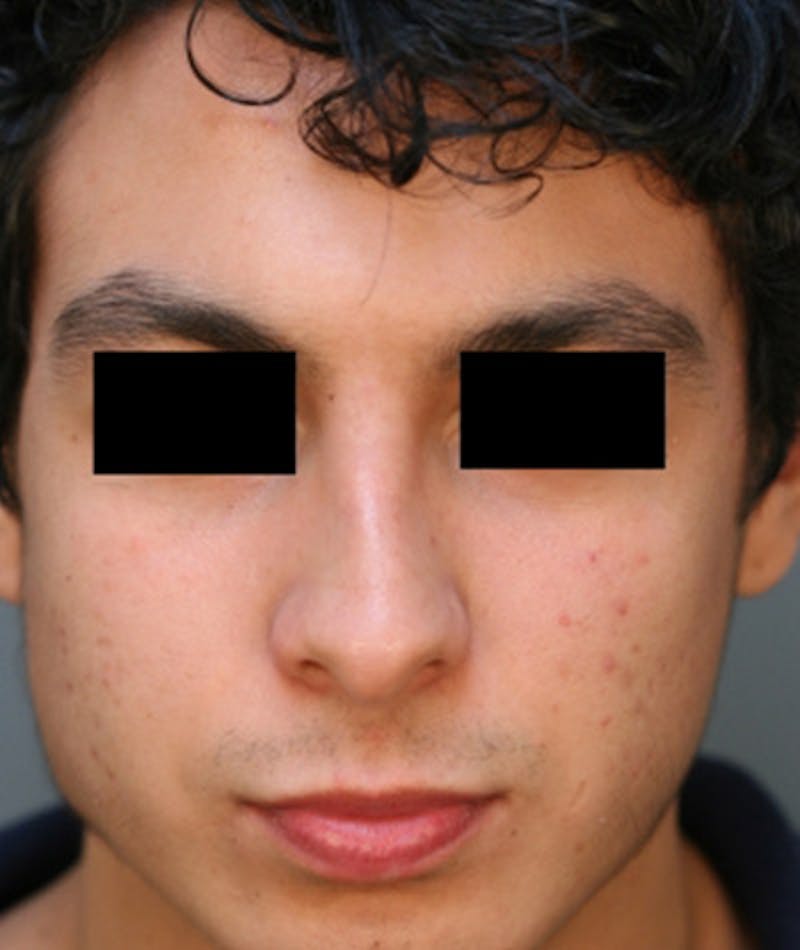 Ethnic Rhinoplasty Before & After Gallery - Patient 108189895 - Image 3