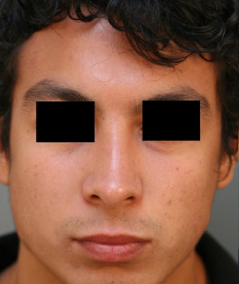 Ethnic Rhinoplasty Before & After Gallery - Patient 108189895 - Image 4