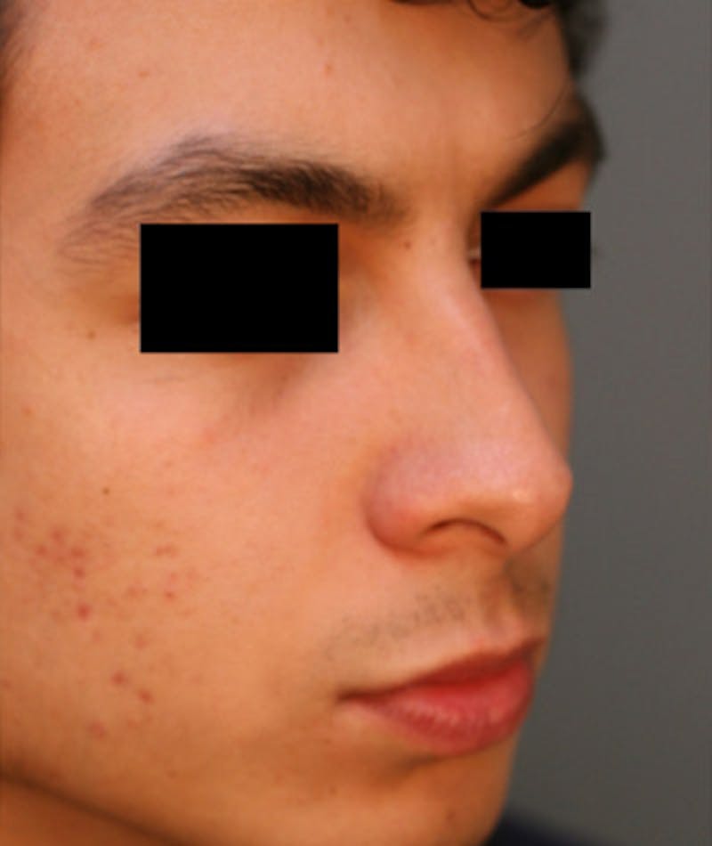 Ethnic Rhinoplasty Before & After Gallery - Patient 108189895 - Image 5