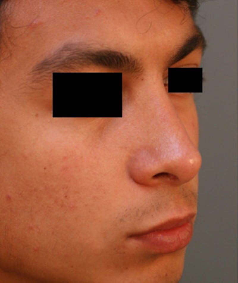 Ethnic Rhinoplasty Before & After Gallery - Patient 108189895 - Image 6