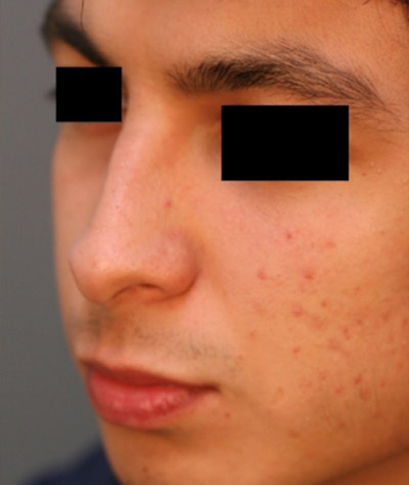 Ethnic Rhinoplasty Before & After Gallery - Patient 108189895 - Image 7
