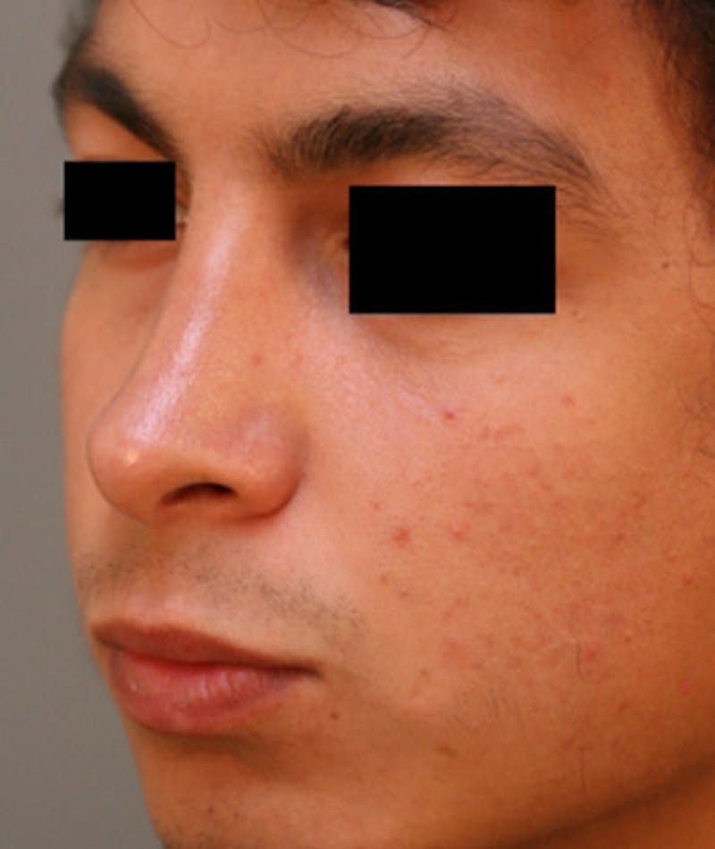 Ethnic Rhinoplasty Before & After Gallery - Patient 108189895 - Image 8