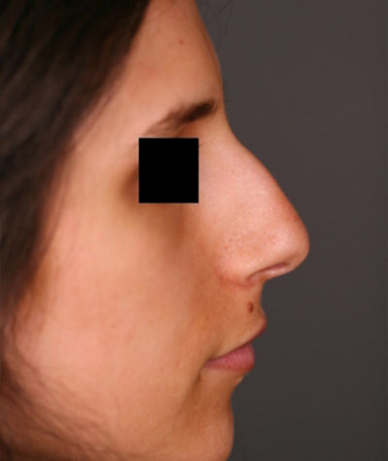 Ethnic Rhinoplasty Before & After Gallery - Patient 108189928 - Image 1