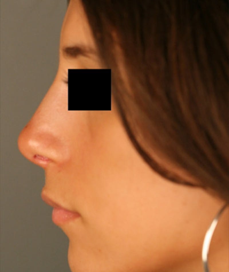 Ethnic Rhinoplasty Before & After Gallery - Patient 108189928 - Image 2
