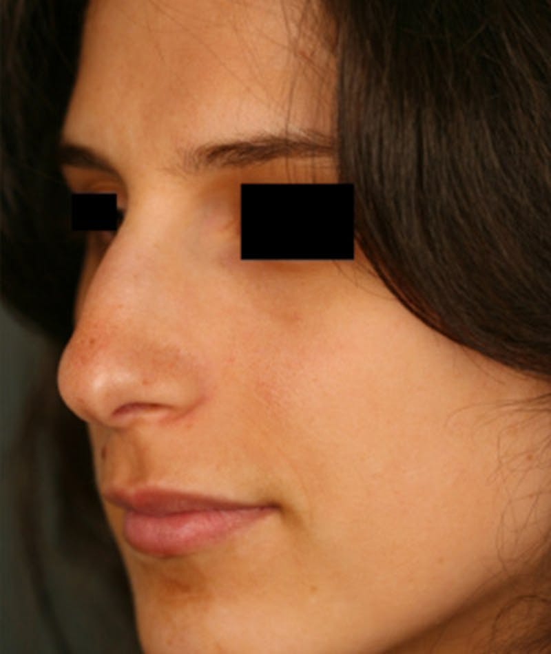 Ethnic Rhinoplasty Before & After Gallery - Patient 108189928 - Image 3