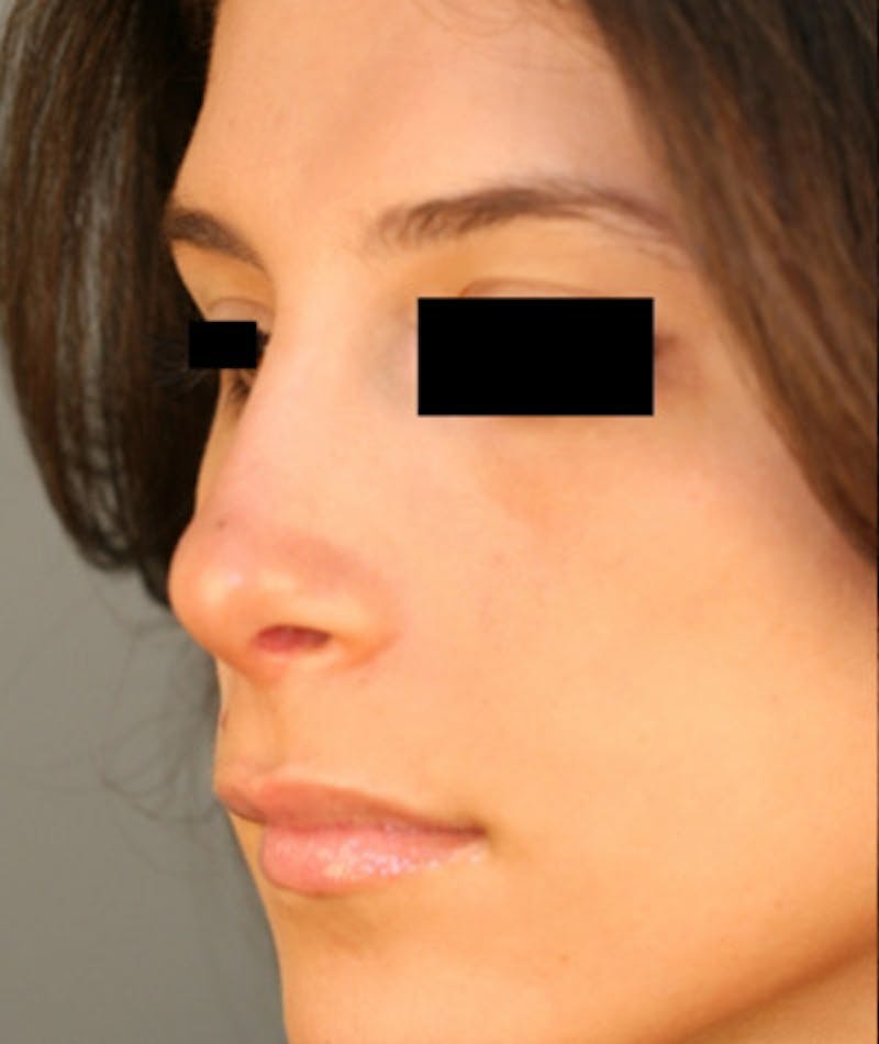 Ethnic Rhinoplasty Before & After Gallery - Patient 108189928 - Image 4