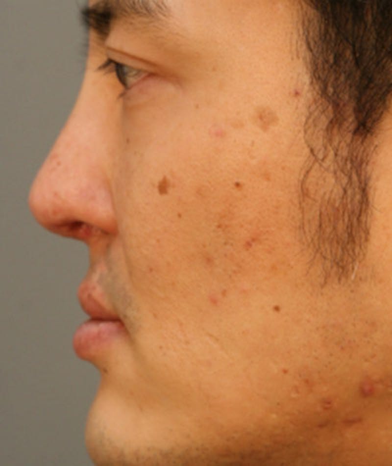 Revision Rhinoplasty Before & After Gallery - Patient 108191377 - Image 2