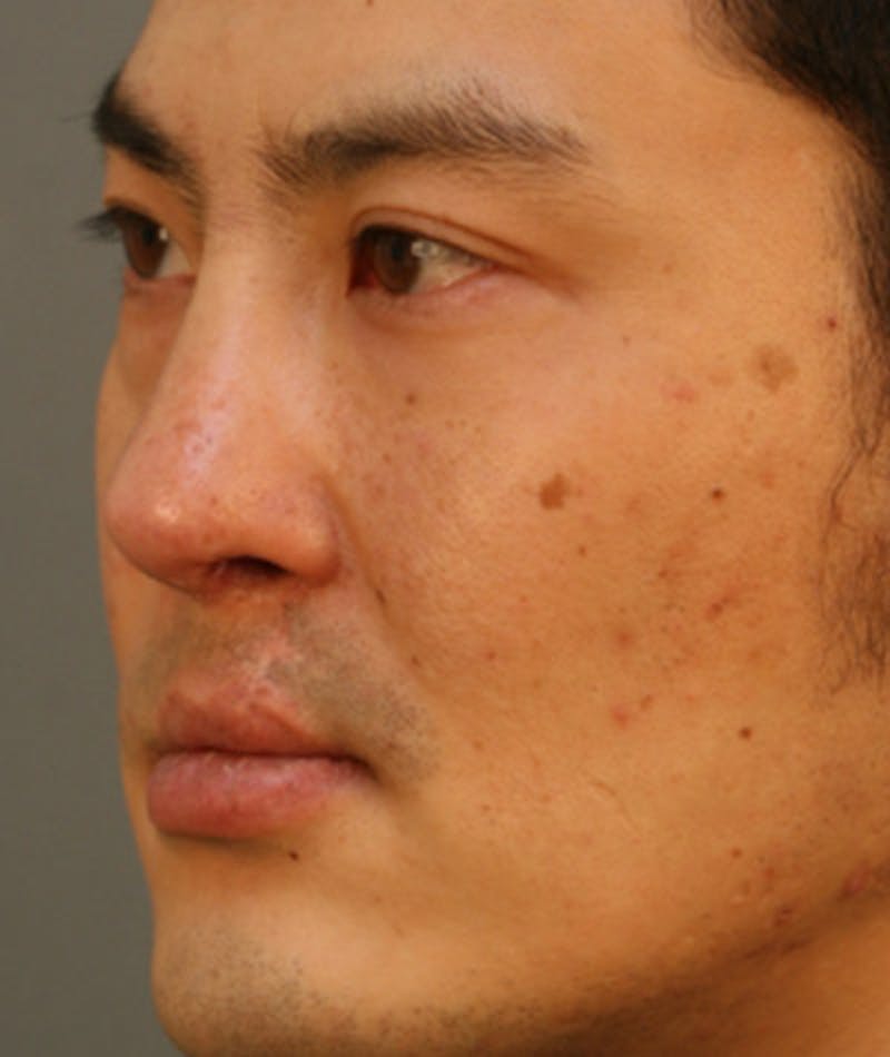 Revision Rhinoplasty Before & After Gallery - Patient 108191377 - Image 6