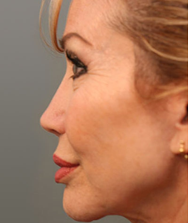 Revision Rhinoplasty Gallery - Patient 108191384 - Image 2