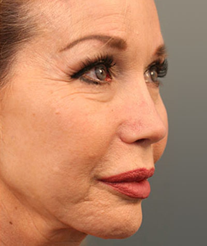 Revision Rhinoplasty Before & After Gallery - Patient 108191384 - Image 4