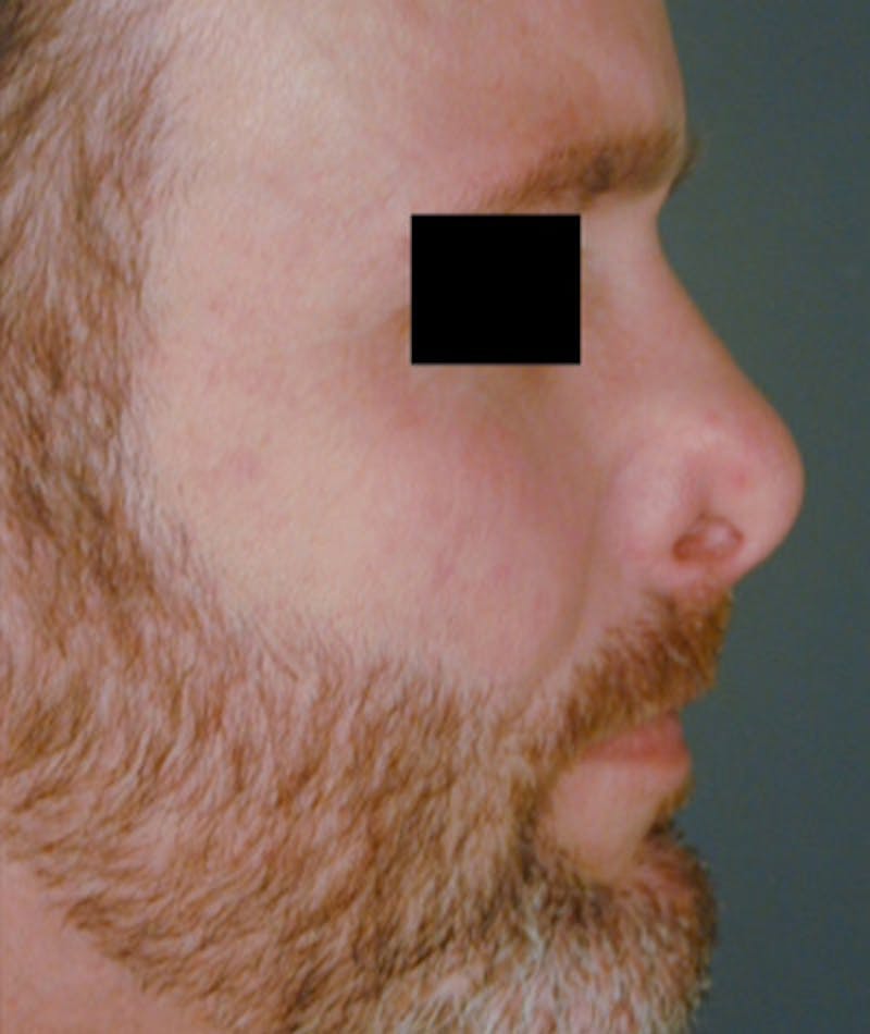 Revision Rhinoplasty Before & After Gallery - Patient 108191396 - Image 1