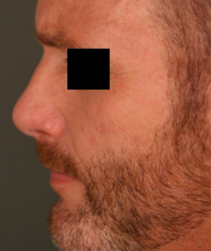 Revision Rhinoplasty Gallery - Patient 108191396 - Image 2