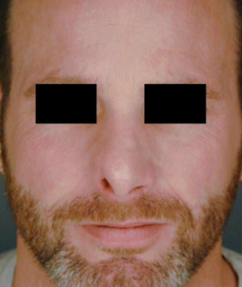 Revision Rhinoplasty Gallery - Patient 108191396 - Image 3