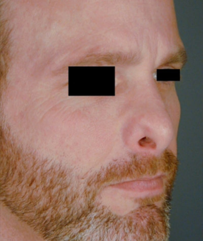 Revision Rhinoplasty Before & After Gallery - Patient 108191396 - Image 5