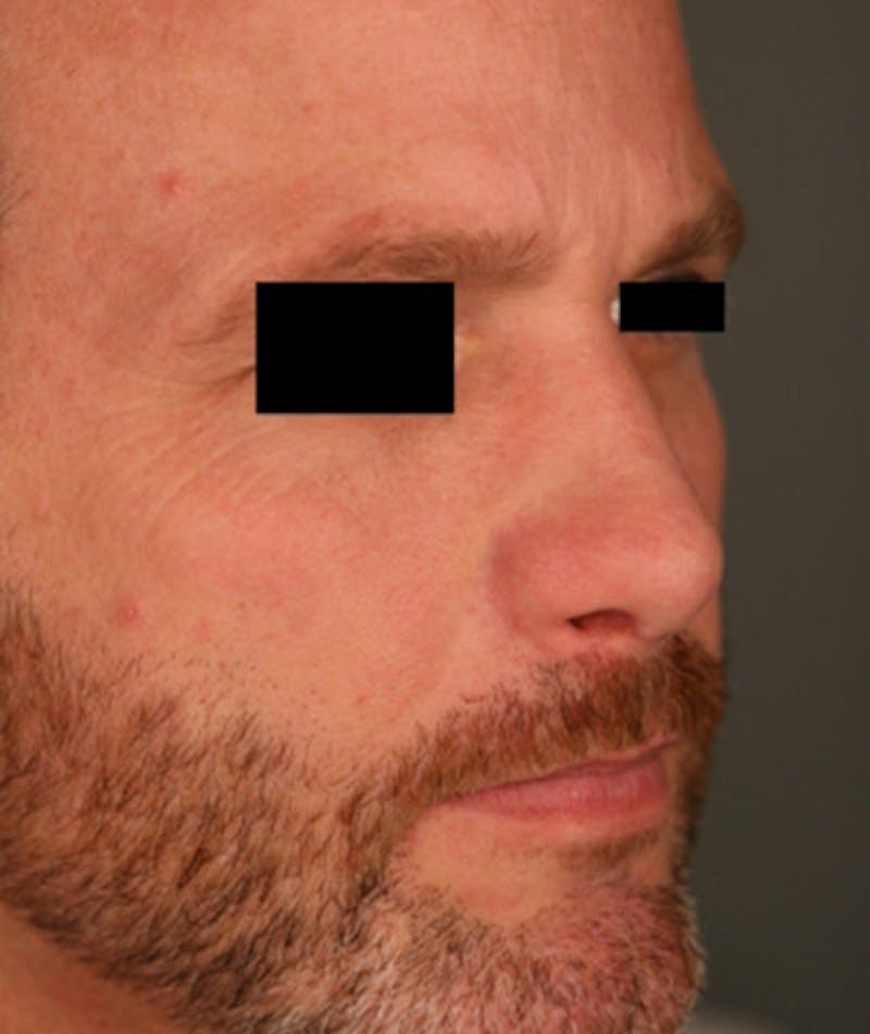 Revision Rhinoplasty Before & After Gallery - Patient 108191396 - Image 6