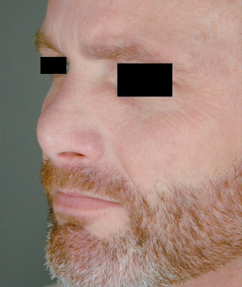 Revision Rhinoplasty Before & After Gallery - Patient 108191396 - Image 7
