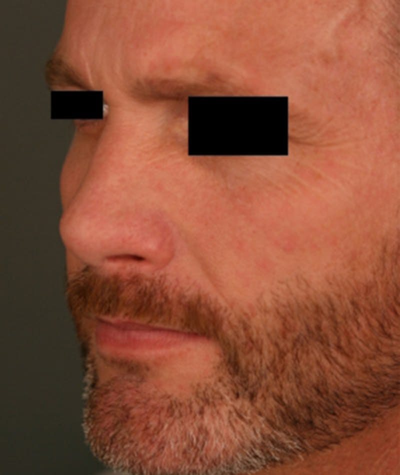 Revision Rhinoplasty Before & After Gallery - Patient 108191396 - Image 8