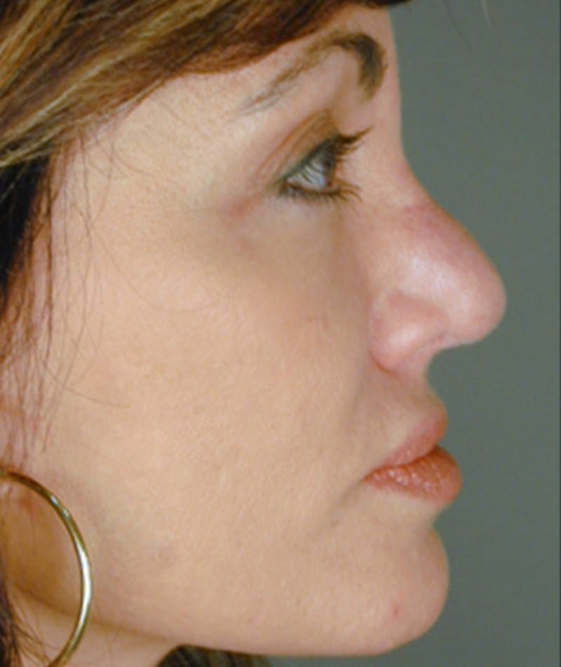 Revision Rhinoplasty Gallery - Patient 108191435 - Image 1