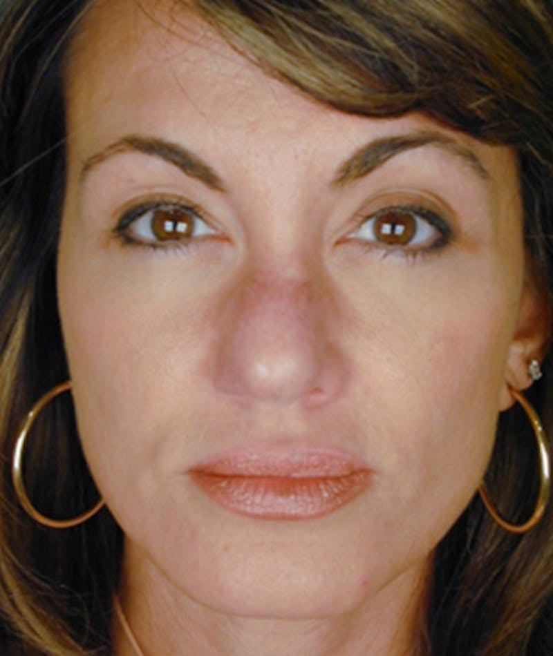 Revision Rhinoplasty Gallery - Patient 108191435 - Image 3