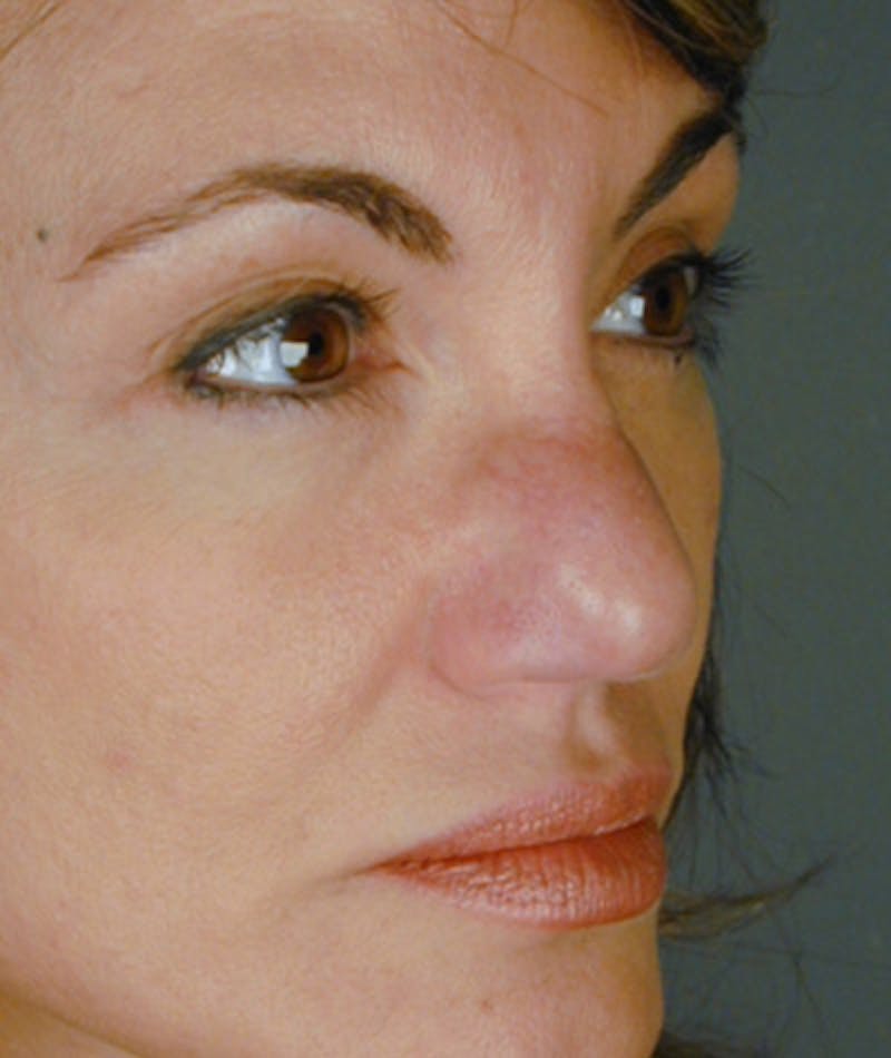 Revision Rhinoplasty Before & After Gallery - Patient 108191435 - Image 5