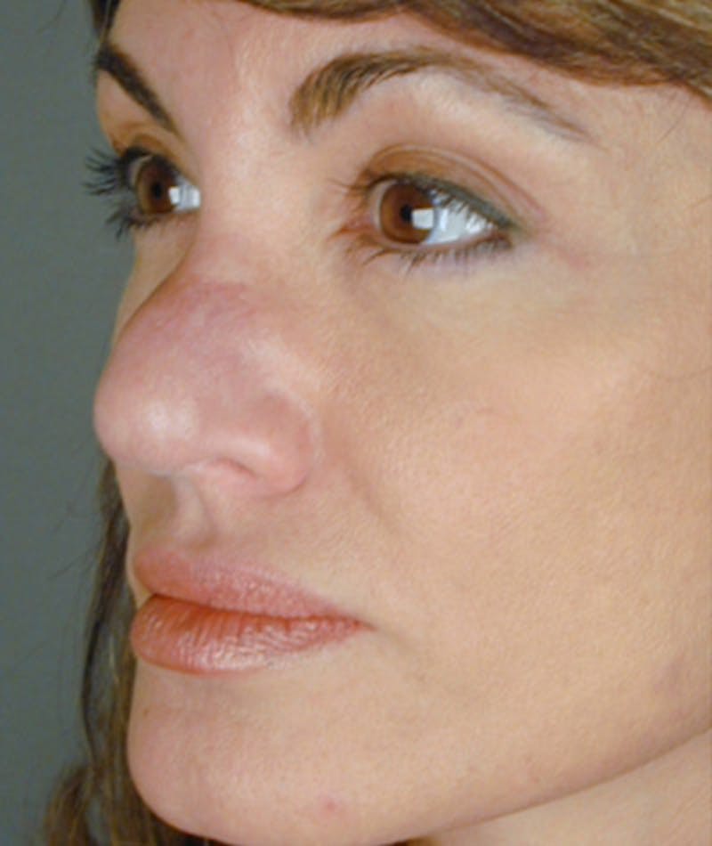 Revision Rhinoplasty Before & After Gallery - Patient 108191435 - Image 7