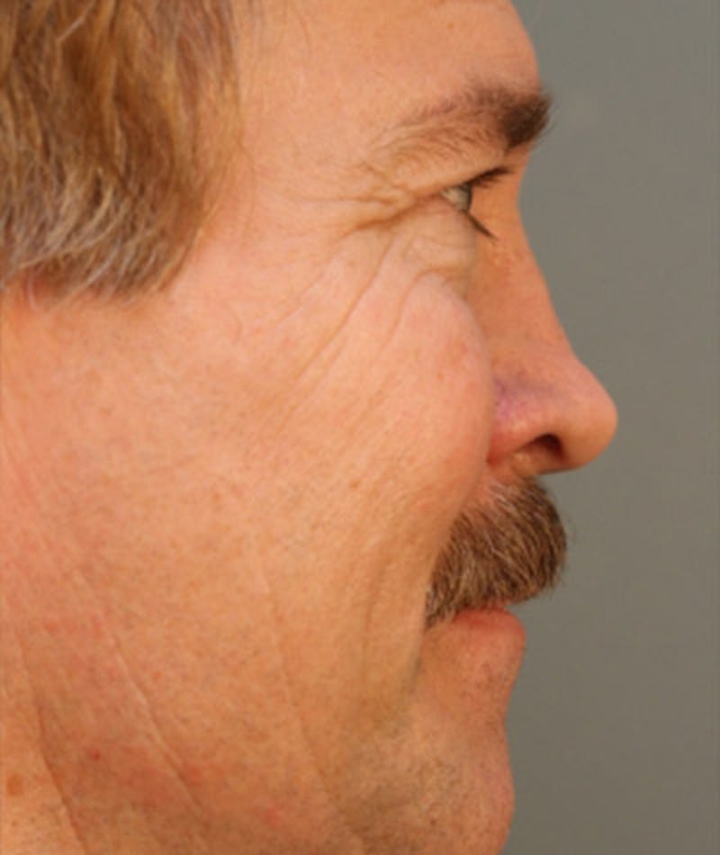 Revision Rhinoplasty Before & After Gallery - Patient 108191449 - Image 1